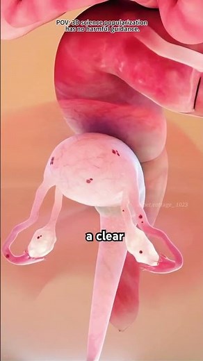 How Laparoscopic Hysterectomy is done (3D Animation)