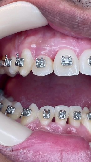 A little triming! 😬 #orthodontist #orthotricks #selfimprovement #ortodoncia #Ortodoncista #Fyp #dramaticmoments #Dental #vegan