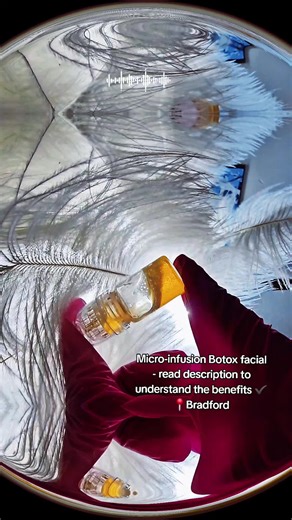 When micro-infusion Botox, skin boosters, and PRP are mixed together and infused into the skin, they work synergistically to improve overall skin quality at multiple levels. The Botox refines the skin by reducing pore size, oil production, and fine surface lines without freezing facial movement, while also improving texture and smoothness. The skin booster provides deep hydration, enhances elasticity, and strengthens the skin barrier for a plumper, healthier appearance. PRP adds powerful regener