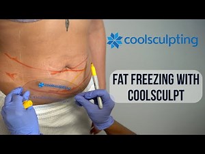 CoolSculpting (Fat Freezing) Procedure | West End Plastic Surgery