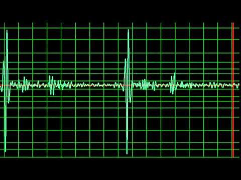 Aortic Regurgitation, Ejection Systolic Murmur- normal speed