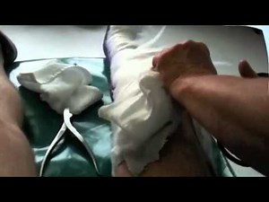 Broken Leg Tibia and Fibula Replace Cast