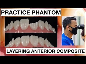 STEP BY STEP HOW TO DIRECT COMPOSITE RESTORATION WITH CLASS IV | General Dentist Griya RR