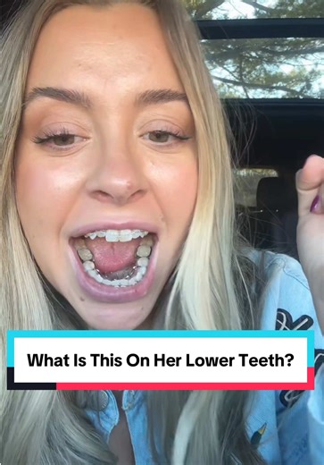#tonguetamers #braces #orthodontist #katytx | tongue tamer