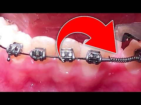 Open Coil Spring, OCS https://www.straightsmilesolutions.com/ Straightwire Ortho