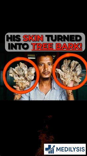This Rare Condition Turns Skin Into Tree Bark. #science #medicalshorts #interesting