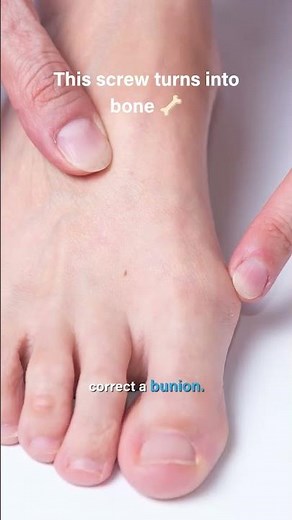 Natural bunion correction using Shark Screw®
