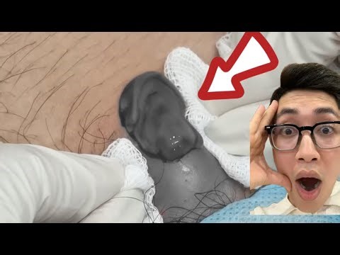 Popping Bikini Abscess Pimples: Watch the Results After Popping!