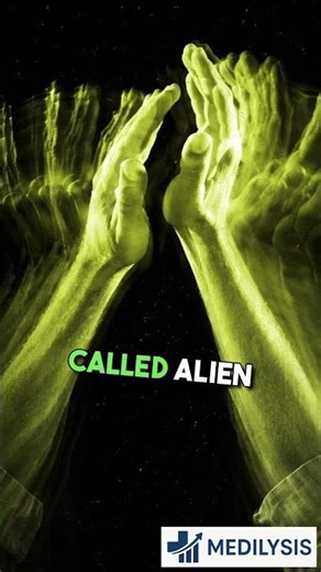 When Your Hand Moves On Its Own 😳 #neuroscience #raredisease #medicalshorts #fyp