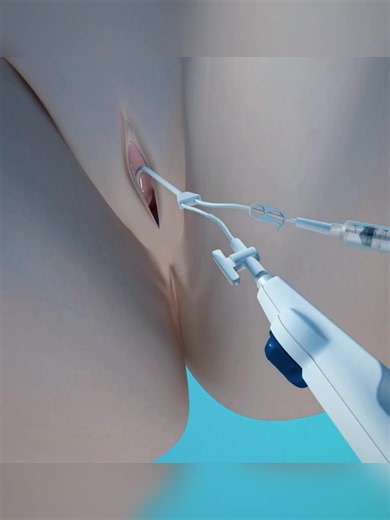 How Tubal Recanalization Can Restore Fertility? #tubalrecanalization #fallopiantubes #fertility #infertility #medicalanimation