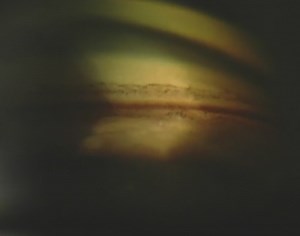 Gonioscopy: Pigmented Angle