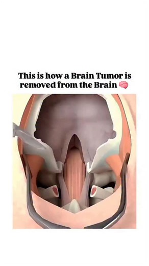 World of Biology | How do surgeons remove a tumor from the brain without damaging vital areas? Brain tumor removal, or craniotomy for tumor excision, is one... | Instagram