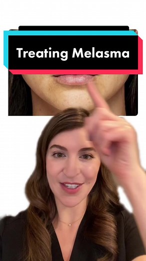 Melasma is a form of hyperpigmentation. It typically appears as symmetric blotchy patches on the cheeks, nose, forehead, chin or upper lip. Melasma can affect anyone but is more commonly seen in women. Avoiding UV exposure and ensuring you wear sunscreen is the best way to help prevent melasma and ensure existing melasma does not worsen. There are a number of other treatments that may be considered (hydroquinone and retinoids can’t be used if pregnant). #drkatiebeleznay #dermatologist #melasma #