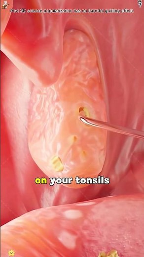 How tonsil stones are form?#tonsils #tonsillitis #tonsilstonesremoval