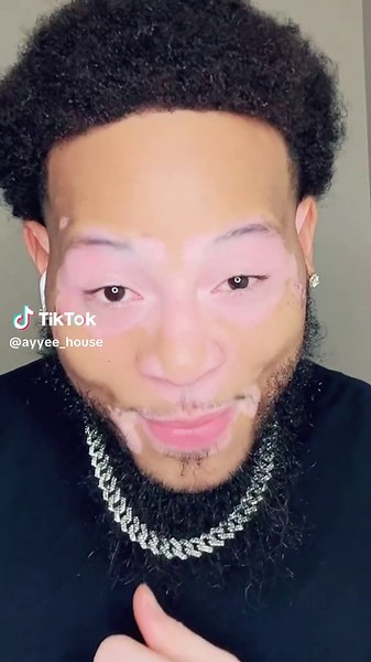 Understanding Vitiligo: Insights and Personal Experiences