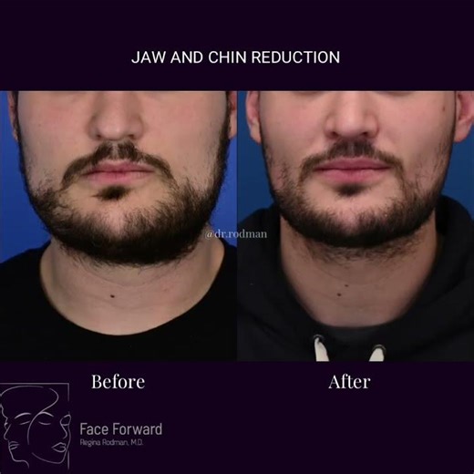 Male Vline surgery