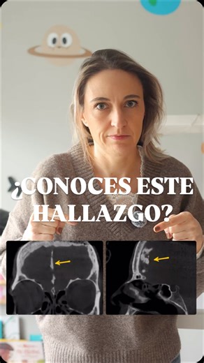 Carolina Martín | CBCT & Endodoncia on Instagram: "🧠Abres un CBCT y ves una calcificación en la línea media. Antes de pensar en patología, conviene saber qué es. La calcificación de la hoz cerebral es un hallazgo relativamente frecuente en adultos. La hoz cerebral es un pliegue de duramadre y, con el tiempo, puede presentar depósitos de calcio como parte de cambios fisiológicos. Radiológicamente suele verse como una línea hiperdensa, bien definida, en la línea media, a nivel de la fosa craneal 