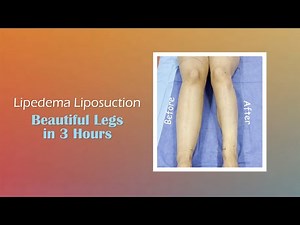 Lipedema Legs | Awake Liposuction | Before and After | Expert Dr. Thomas Su
