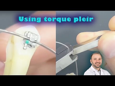 Apply torque for single tooth on orthodontic wire with torque pliers, change tipping of single tooth