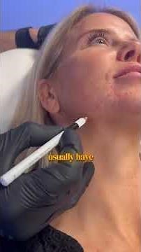 How to improve the jawline with Botox