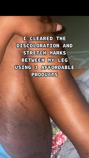 I cleared the discoloration and stretch marks between my legs using three affordable products from Ngolo Natural Secrets. I used the Radiant Solve Soap, Radiant Solve Scrub, and Dark Spots Remover Cream. I highly recommend these products for someone going through the same situation. The results were visible in just a few weeks, and what's great is that these products don't contain bleaching agents.
