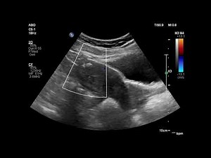 Dystrophic Myometrial Calcification on Ultrasound: Understanding Benign Uterine Findings