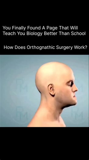 Anatomy | Physiology | Body facts on Instagram: "How Does Orthognathic Surgery Work? 🦷🦴 Orthognathic surgery, also known as corrective jaw surgery, is a medical procedure that fixes irregularities of the jaw bones to improve both function and facial appearance. It’s commonly recommended when the upper and lower jaws don’t align properly, causing problems with chewing, speaking, breathing, or facial balance. The process usually begins with orthodontic treatment. Braces or aligners are used to m