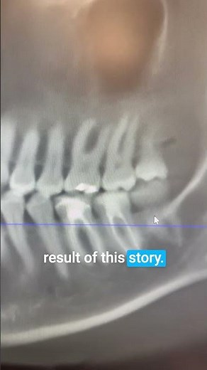 She beat terminal breast cancer — after removing two infected root canals #shorts