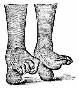 Medical illustration of a human foot with talipes type calcaneovalgus...