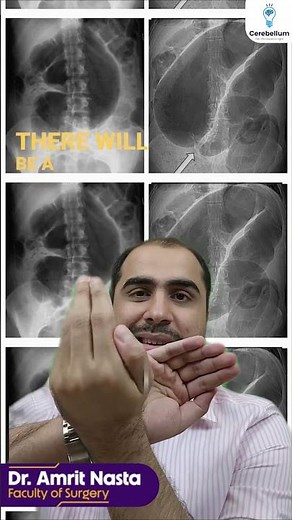 SIGMOID OR CECAL VOLVULUS? | Cerebellum Academy