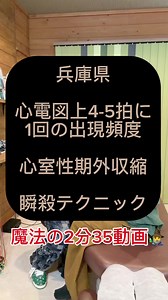 心室性期外収縮の理解と対処法