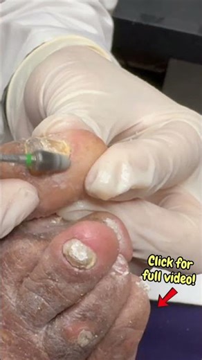 Grinding Down an Extremely Thick Toenail #satisfyingshorts #nailcutting