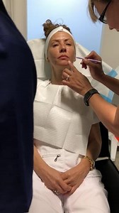 MINT PDO Face Thread Lift pre-op