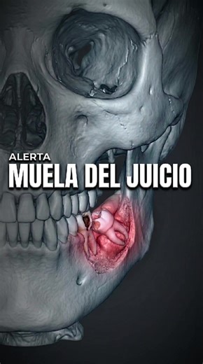 ¿Qué pasaría si no te quitas las muelas del juicio?Muchas veces las muelas del juicio no causan dolor… al principio. Pero cuando se quedan atrapadas o salen en mala posición, pueden empezar a empujar al diente de al lado sin que lo notes. Esa presión constante crea espacios donde la caries avanza en silencio. El esmalte se debilita, la encía se inflama y, en algunos casos, hasta la raíz puede verse afectada. Cuando finalmente aparece el dolor, el daño ya puede ser profundo. No siempre es cuestió