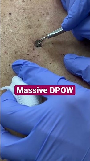 Massive Dilated Pore of Winer DPOW Removal
