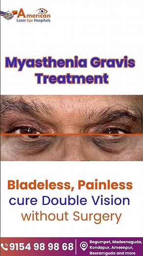 What Causes Double Vision? | #ytshorts #healthtips #eyecare #doublevision #myastheniagravis