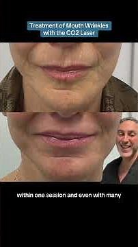 Treatment of Mouth Wrinkles with the CO2 Laser