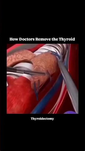 ##thyroidectomy 💉💊💯🫀