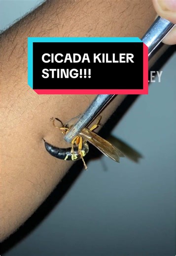 Large, sturdy, robust, but above all, beautiful! This wasp is one of my personal favorites. I went ahead and took a few stings in my forearm from this female Eastern Cicada Killer (Sphecius speciosus). This may come as a surprise to many, but the venom delivered from this species is on par with most paper wasp stings, in my personal opinion of course. Eastern Cicada Killers specifically use their venom to paralyze cicadas. For this reason, these large wasps have no interest in going after and st