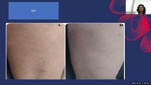 Innovative Use of 5 FU Bleomycin and Methotrexate