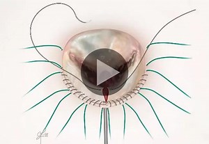 Demystifying Mitral Valve Repair (Video)