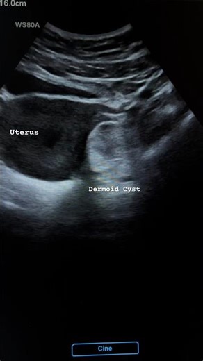 Adenexal Dermoid Cyst Ultrasound | ARDMS | Sonography | Ob-gyn