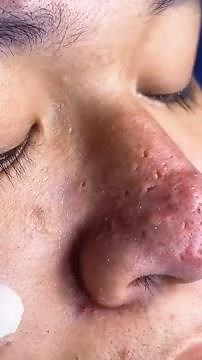 Cleaning Nose Full Of Blackheads !