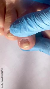toenail with fungal infection or damage, close-up of nail health problems, nail fungus, doctor examining diseased toenails