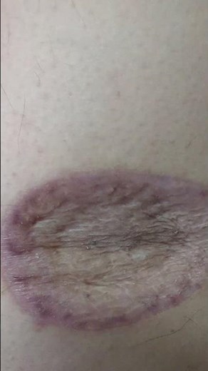 2/22 Today's rare cancer melanoma and Opdivo side effects (´・ω・`)