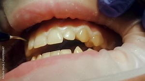 On incisors, liquid rubber dam, composite, photopolymer for bleaching is applied