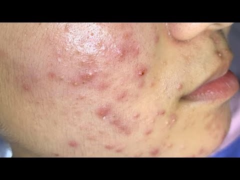 AWESOME HIDDEN ACNE REMOVAL | Suri Job 122
