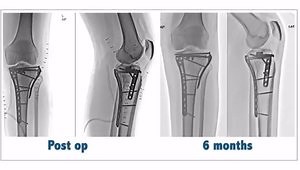 Posteromedial Fixation in Tibial Plateau Fractures
