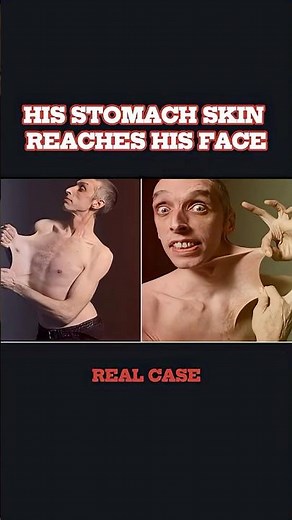 The stretchiest skin record #mystery #guinnessrecord #medical #rare
