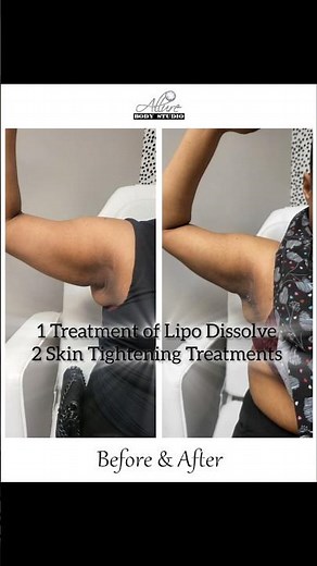 Lipo Dissolve on Arms. Before and after!